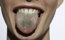 印度医生首次将3D打印技术用于舌癌手术